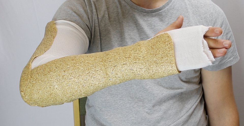 Three splints in 97 seconds with the Woodcast OneStep