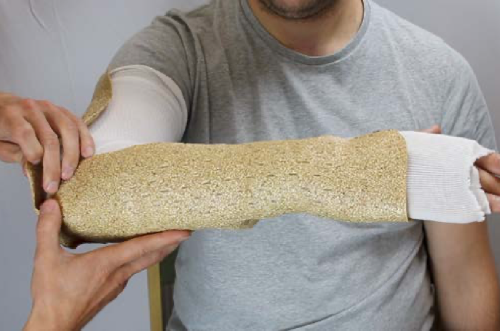 Above elbow splint