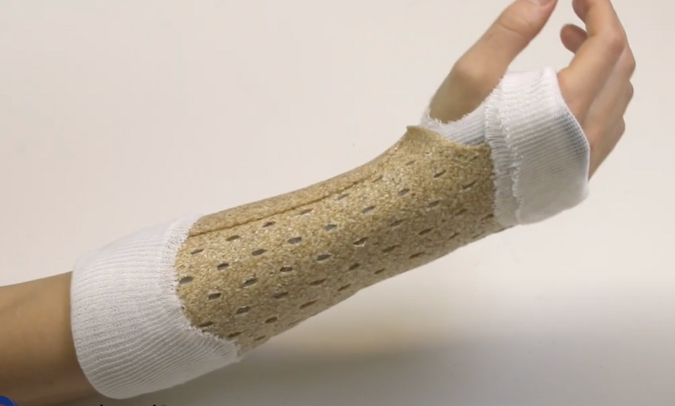 Circumferential Arm Cast with Woodcast